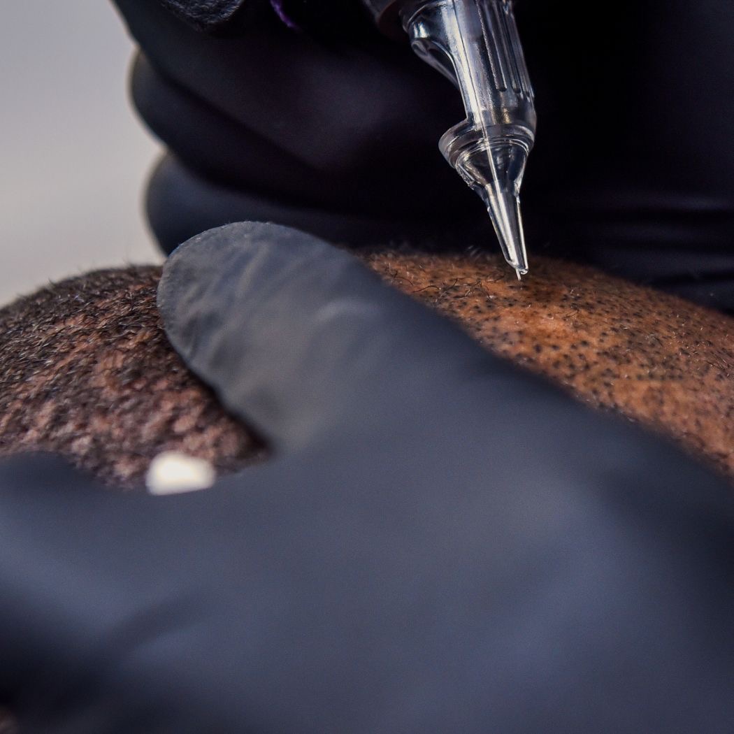 Kopfhaut- / Haaransatzpigmentierung bei Elegance Aesthetics