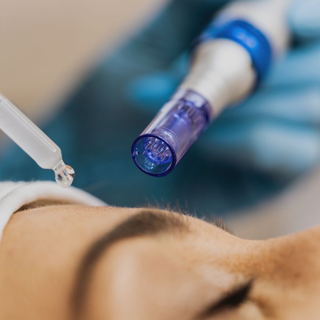 Microneedling bei Elegance Aesthetics