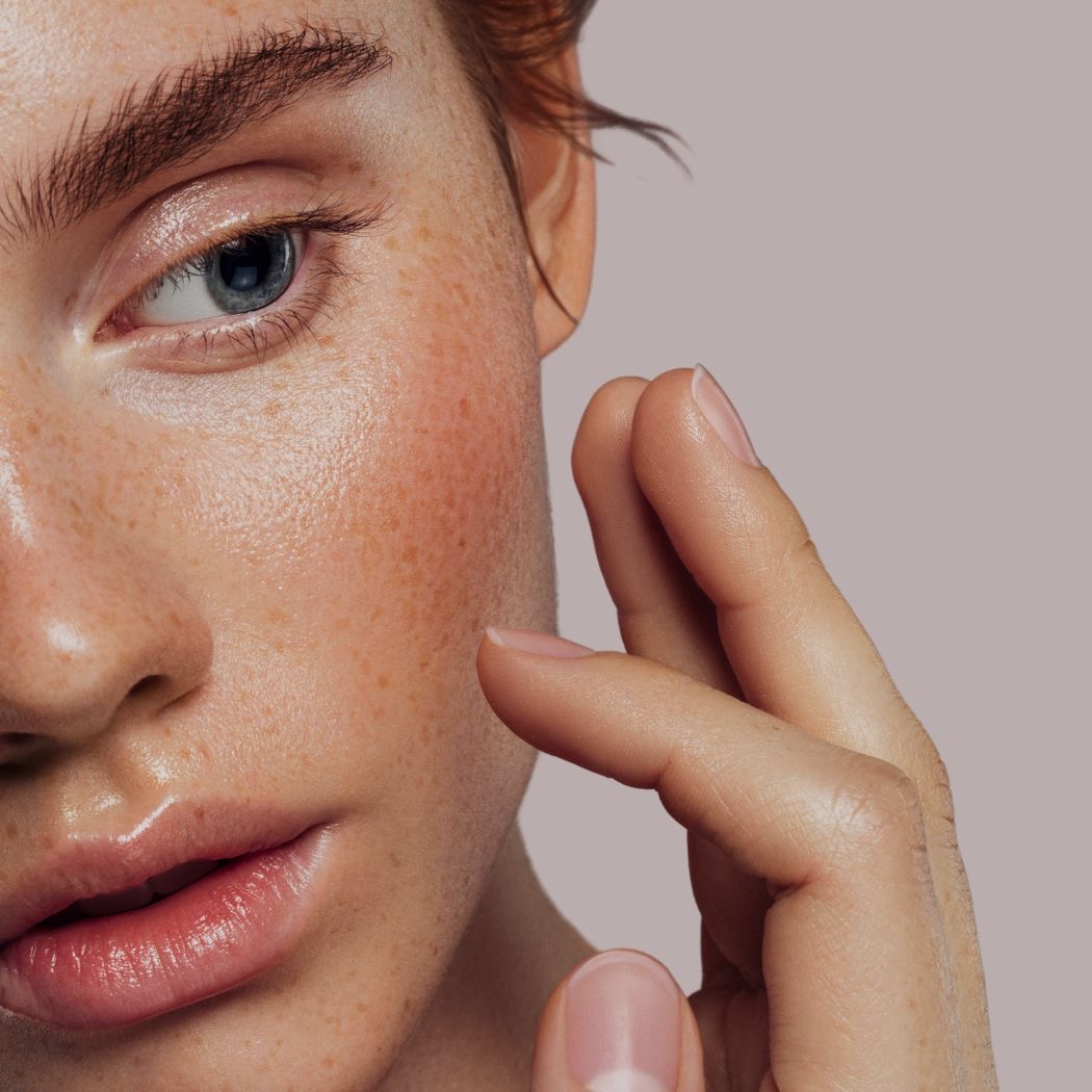 Sommersprossen bei Elegance Aesthetics